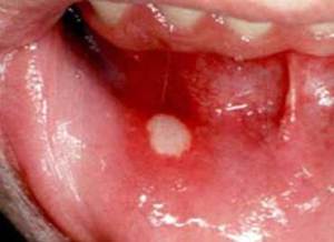 aftas-bucales1