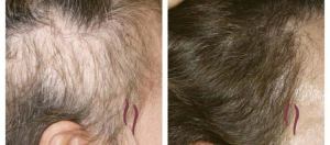 alopecia-en-mujeres-clinica-capilar-barcelona-750x330