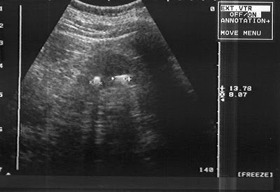 Eco Calculos Renales