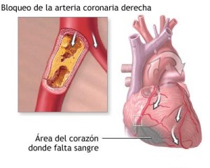 Cardiopatía Diabética
