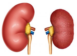 Nefropatía Diabética