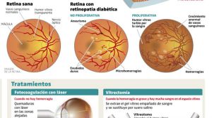 Retinopatía Diabética